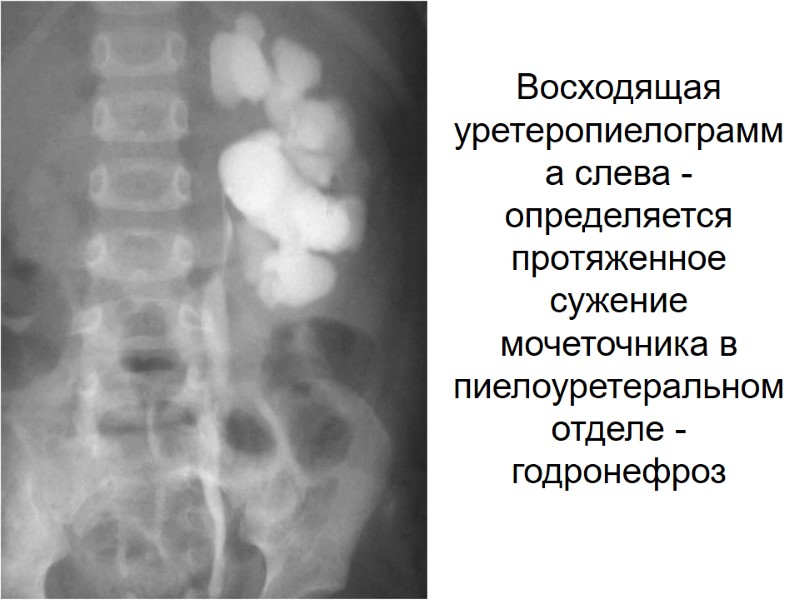 Восходящая уретеропиелограмма слева - определяется протяженное сужение мочеточника в пиелоуретеральном отделе - годронефроз